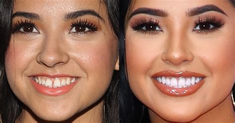 becky g teeth